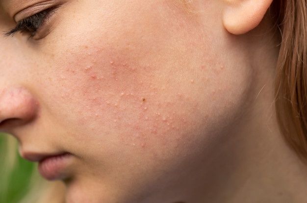 Premium Photo Close up face of a young girl with skin problems